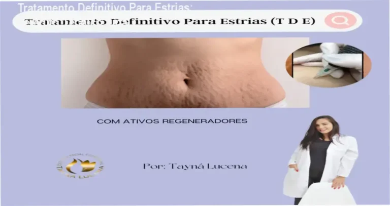 Demonstração da técnica de regeneração dérmica do método Tratamento Definitivo Para Estrias
